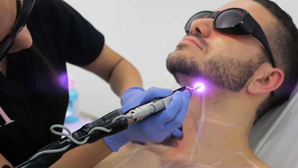 Light Blue Laser Hair Removal - wide 5