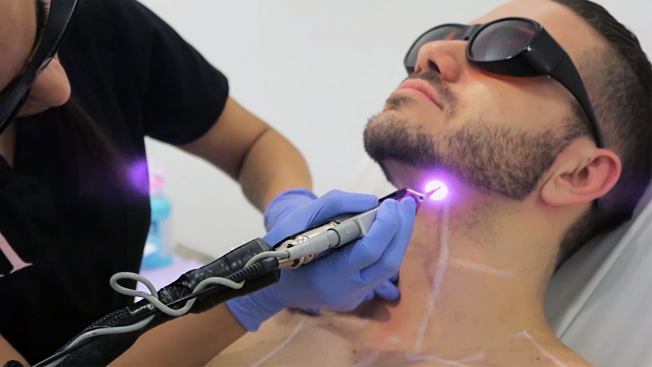 LASER HAIR REMOVAL FOR MALE
